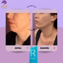 Resultados antes y después